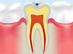 CO【初期の虫歯】