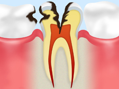 C3【神経に達した虫歯】